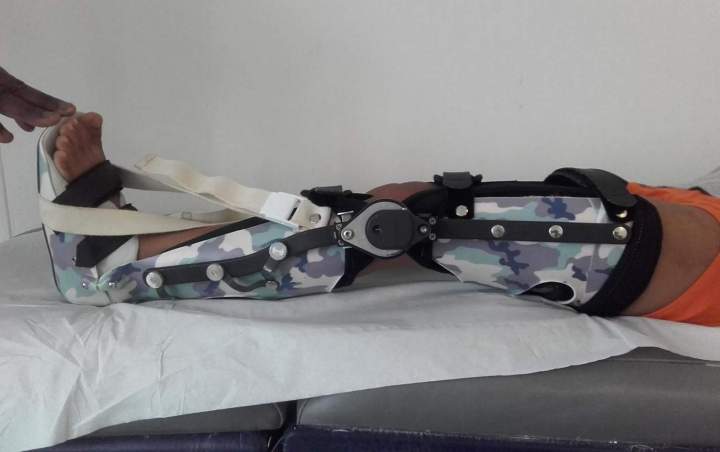 Pose d'appareil orthopédique Antilles et Guyane