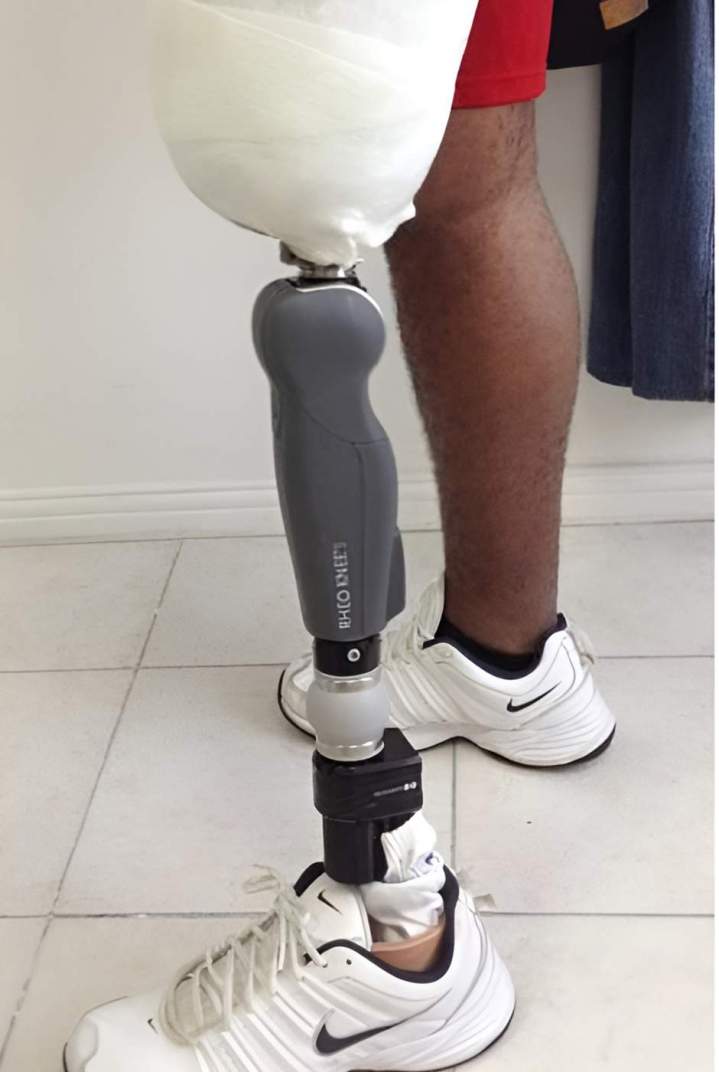 Appareillage prothétique Antilles et Guyane