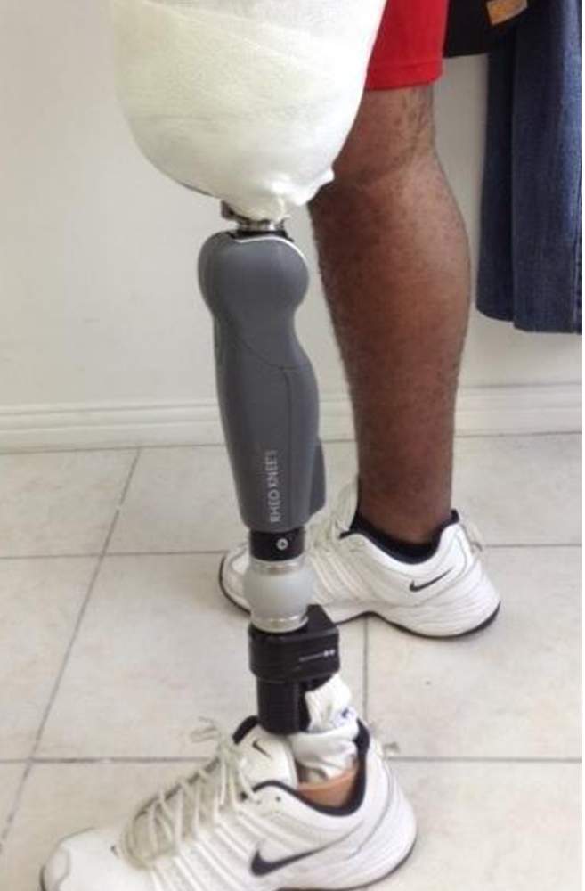 Conception de prothèses externes sur mesure pour retrouver votre mobilité